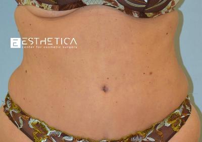 Tummy Tuck after at Esthetica Of San Diego and Dr. Wael Kouli in Coronado, CA