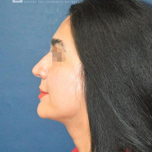 Esthetica Of San Diego and Dr. Wael Kouli facelift after — Coronado, CA