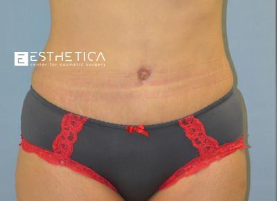 Esthetica Of San Diego and Dr. Wael Kouli tummy tuck after — Coronado, CA