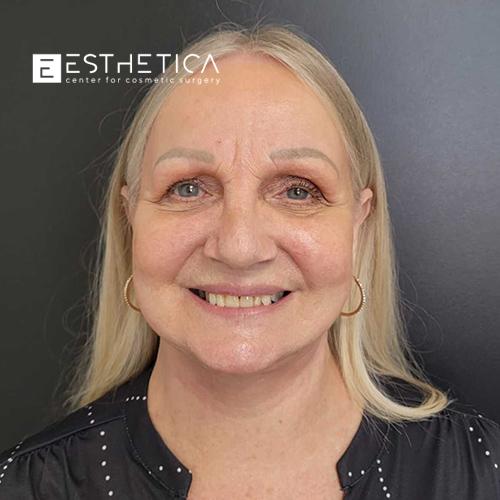 Esthetica Of San Diego and Dr. Wael Kouli facelift after — Coronado, CA