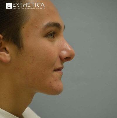 Esthetica Of San Diego and Dr. Wael Kouli rhinoplasty after — Coronado, CA