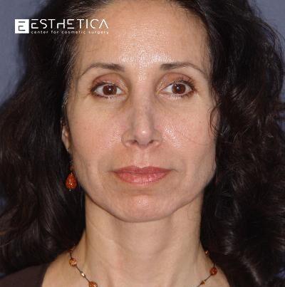 Esthetica Of San Diego and Dr. Wael Kouli rhinoplasty after — Coronado, CA