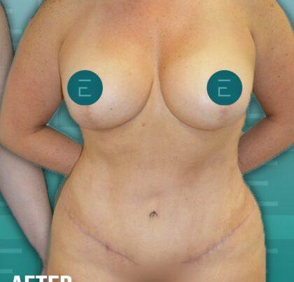Esthetica Of San Diego and Dr. Wael Kouli tummy tuck after — Coronado, CA