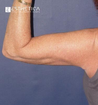 Arm Lift after at Esthetica Of San Diego and Dr. Wael Kouli in Coronado, CA