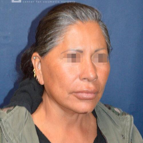 Esthetica Of San Diego and Dr. Wael Kouli facelift after — Coronado, CA