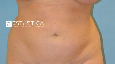 Esthetica Of San Diego and Dr. Wael Kouli after — Coronado, CA