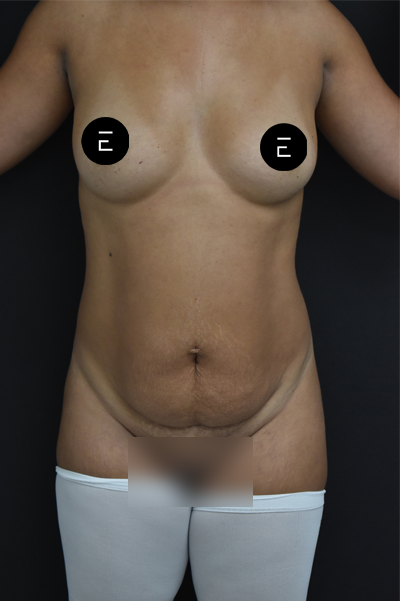 Breast Augmentation before at Esthetica Of San Diego and Dr. Wael Kouli in Coronado, CA