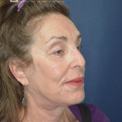 Blepharoplasty after at Esthetica Of San Diego and Dr. Wael Kouli in Coronado, CA