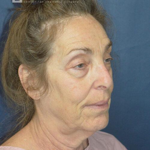 Blepharoplasty before at Esthetica Of San Diego and Dr. Wael Kouli in Coronado, CA