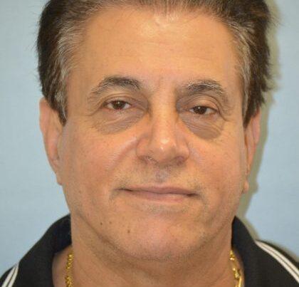 Esthetica Of San Diego and Dr. Wael Kouli rhinoplasty after — Coronado, CA