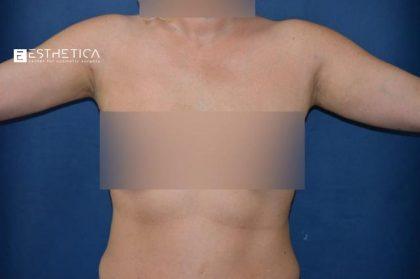 Esthetica Of San Diego and Dr. Wael Kouli after — Coronado, CA