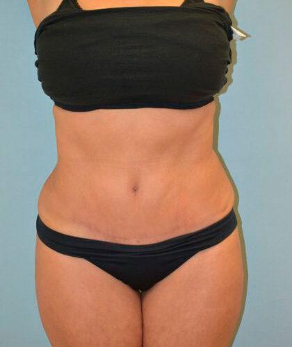 Esthetica Of San Diego and Dr. Wael Kouli tummy tuck after — Coronado, CA