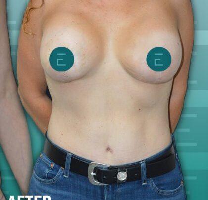 Mommy Makeover after at Esthetica Of San Diego and Dr. Wael Kouli in Coronado, CA