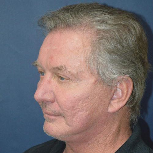 Esthetica Of San Diego and Dr. Wael Kouli facelift after — Coronado, CA