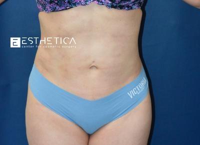 Esthetica Of San Diego and Dr. Wael Kouli after — Coronado, CA