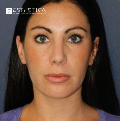 Esthetica Of San Diego and Dr. Wael Kouli rhinoplasty after — Coronado, CA