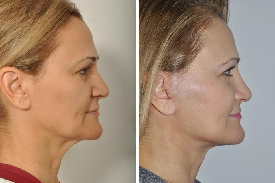Benjamin Paul, MD facelift result — New York, NY