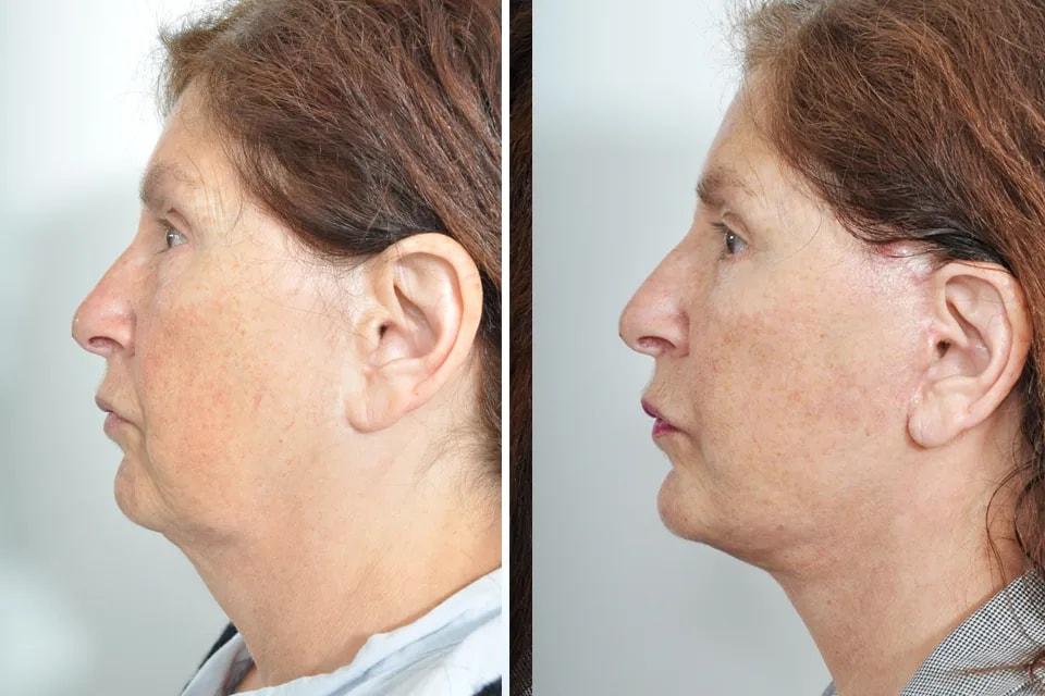 Benjamin Paul, MD facelift result — New York, NY