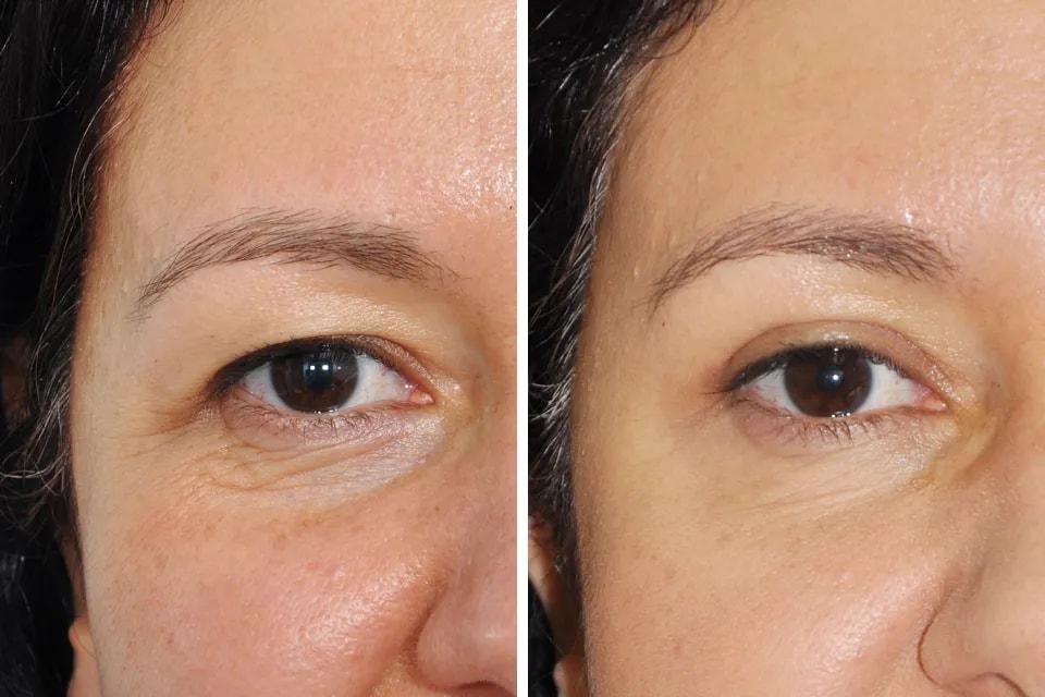 Benjamin Paul, MD eyelid lift result — New York, NY