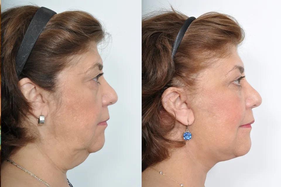 Benjamin Paul, MD facelift result — New York, NY