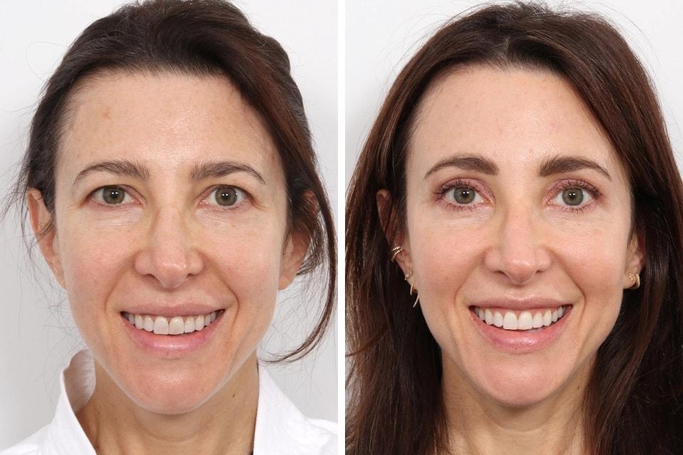 Benjamin Paul, MD brow lift result — New York, NY