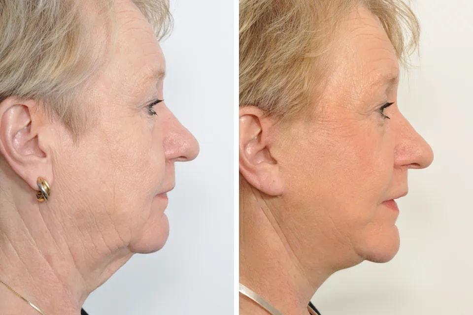 Benjamin Paul, MD facelift result — New York, NY