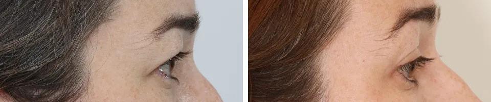 Benjamin Paul, MD eyelid lift result — New York, NY