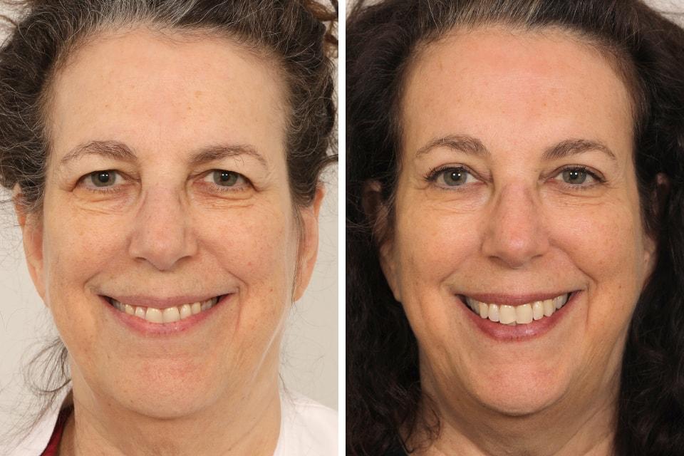 Benjamin Paul, MD brow lift result — New York, NY