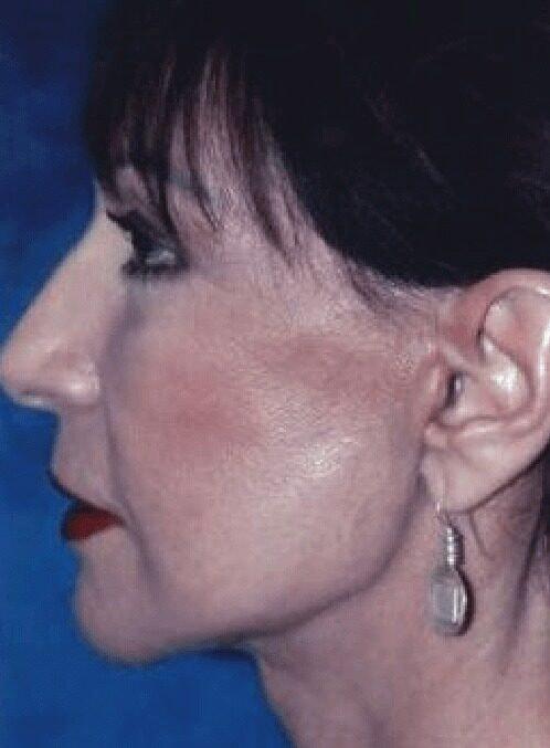 Harrison H Lee, MD facelift after — Beverly Hills, CA