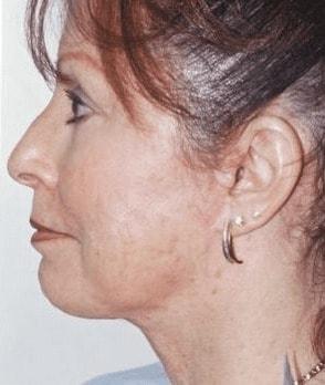 Harrison H Lee, MD neck lift after — Beverly Hills, CA