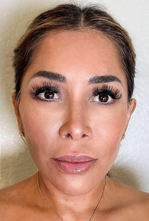 Harrison H Lee, MD facelift after — Beverly Hills, CA