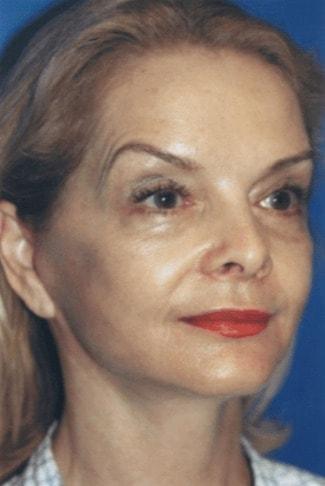 Harrison H Lee, MD facelift after — Beverly Hills, CA