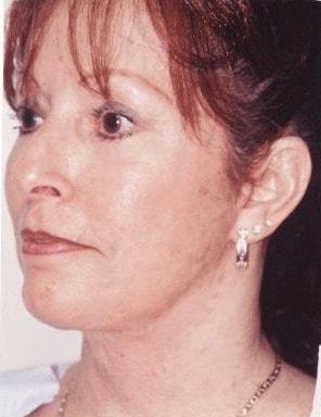 Harrison H Lee, MD neck lift after — Beverly Hills, CA
