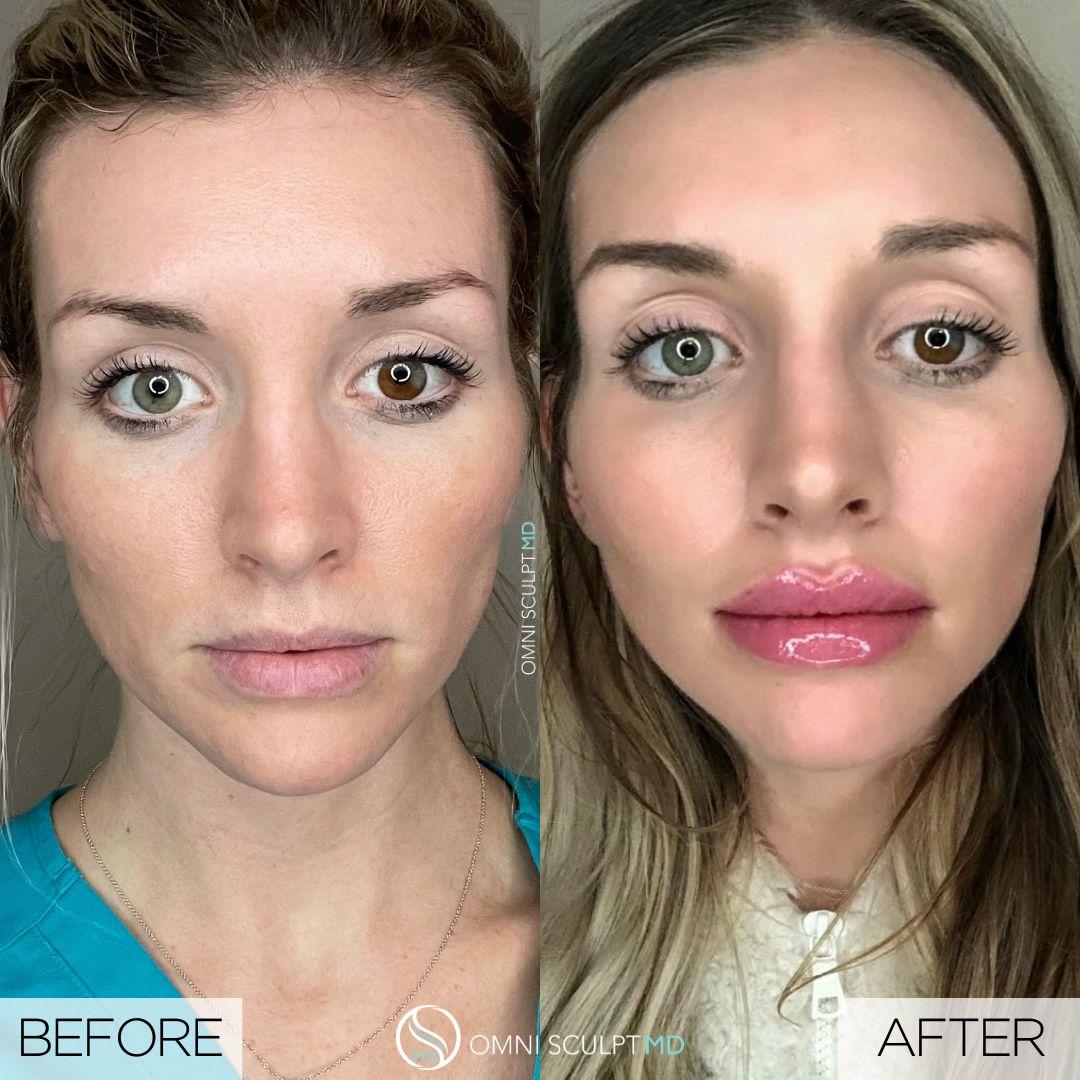 OMNI SCULPT MD result — Dallas, TX
