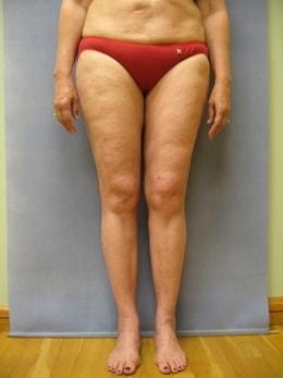 Liposuction after at Wandra K. Miles, MD in Seattle, WA