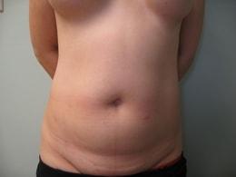 Liposuction before at Wandra K. Miles, MD in Seattle, WA