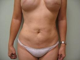Wandra K. Miles, MD liposuction after — Seattle, WA