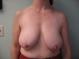 Breast Reduction before at Wandra K. Miles, MD in Seattle, WA
