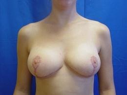 Wandra K. Miles, MD breast reduction after — Seattle, WA