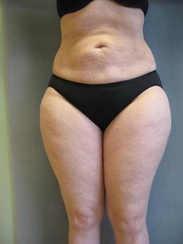 Liposuction before at Wandra K. Miles, MD in Seattle, WA
