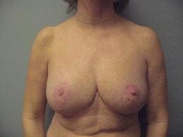 Wandra K. Miles, MD breast reduction after — Seattle, WA