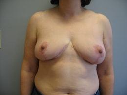 Breast Reduction after at Wandra K. Miles, MD in Seattle, WA