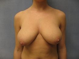 Breast Reduction before at Wandra K. Miles, MD in Seattle, WA