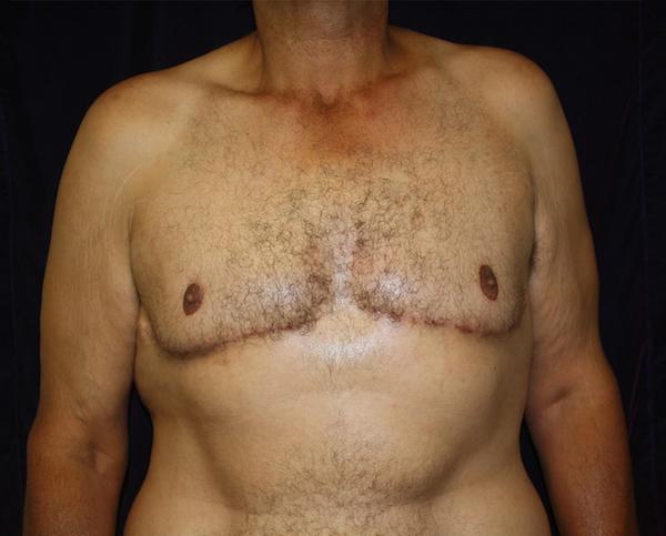 Gynecomastia Surgery after at Dr. Zarrabi Plastic Surgery in Los Angeles, CA