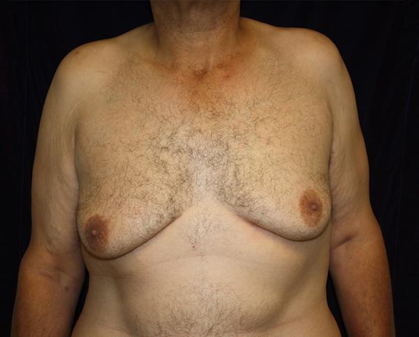 Gynecomastia Surgery before at Dr. Zarrabi Plastic Surgery in Los Angeles, CA