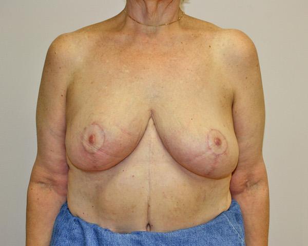 Breast Reduction after at Dr. Zarrabi Plastic Surgery in Los Angeles, CA