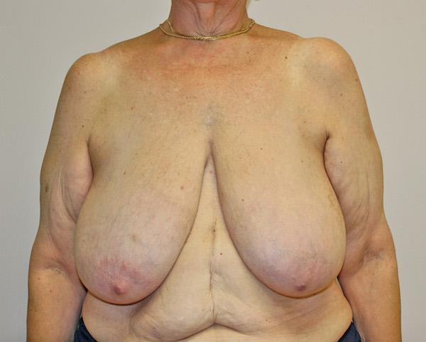 Breast Reduction before at Dr. Zarrabi Plastic Surgery in Los Angeles, CA