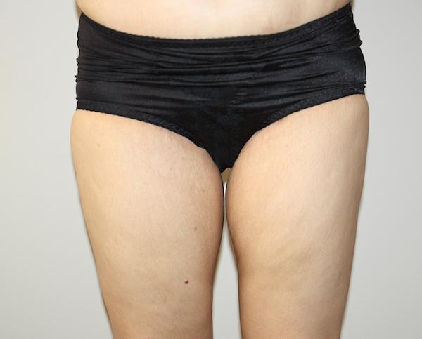 Mini Tummy Tuck after at Dr. Zarrabi Plastic Surgery in Beverly Hills, CA