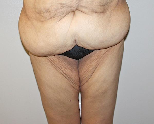 Mini Tummy Tuck before at Dr. Zarrabi Plastic Surgery in Beverly Hills, CA