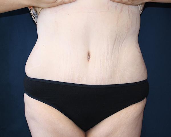 Tummy Tuck after at Dr. Zarrabi Plastic Surgery in Los Angeles, CA